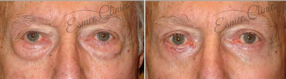 Before and After img